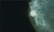 Breast Cancer Risk-Should I get screened?