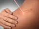 How to Remove a Scar: Modern Medical Approaches That Actually Help